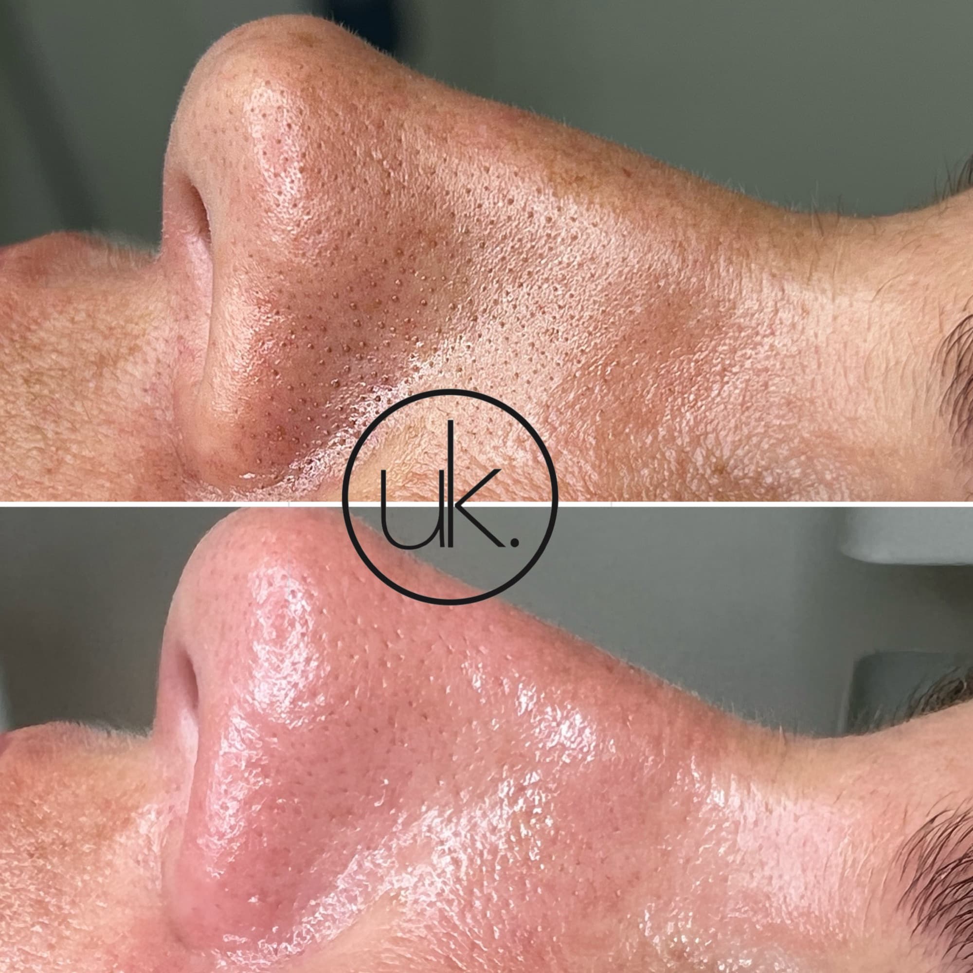 Aquafacial in der UK Kosmetik Academy Velbert