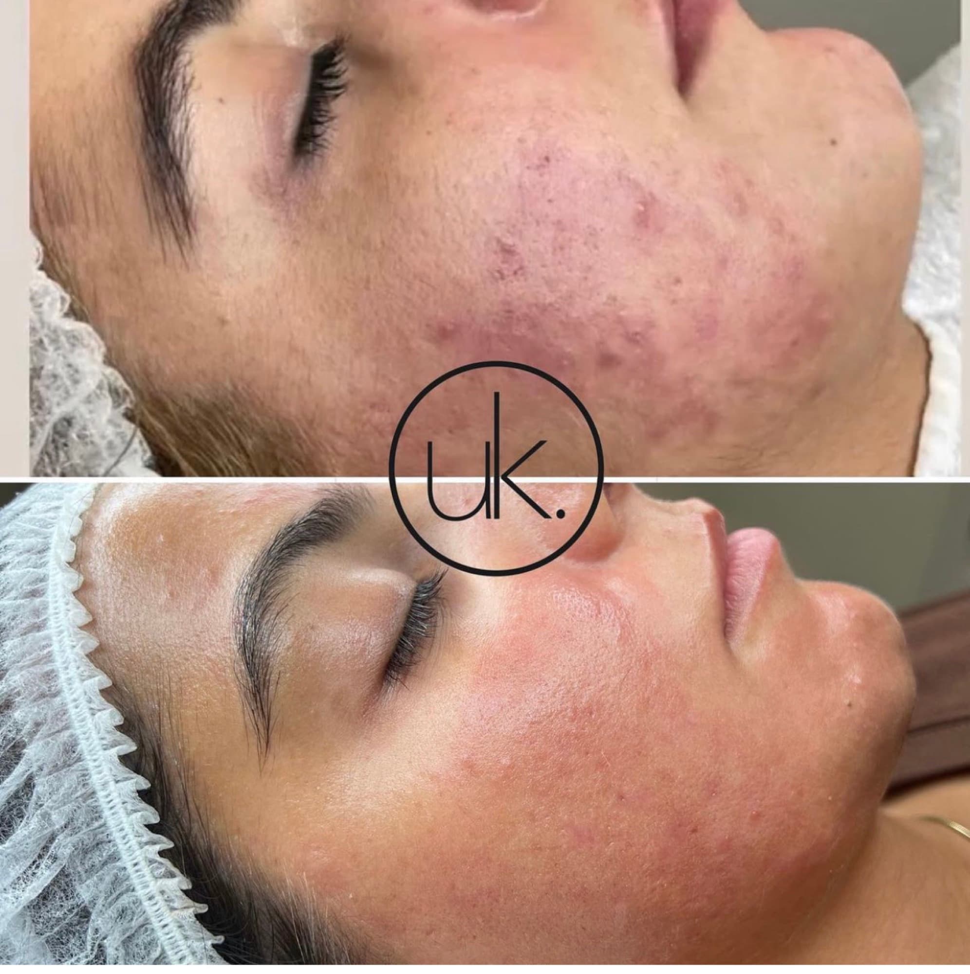 Biorepeel in der UK Kosmetik Academy Velbert
