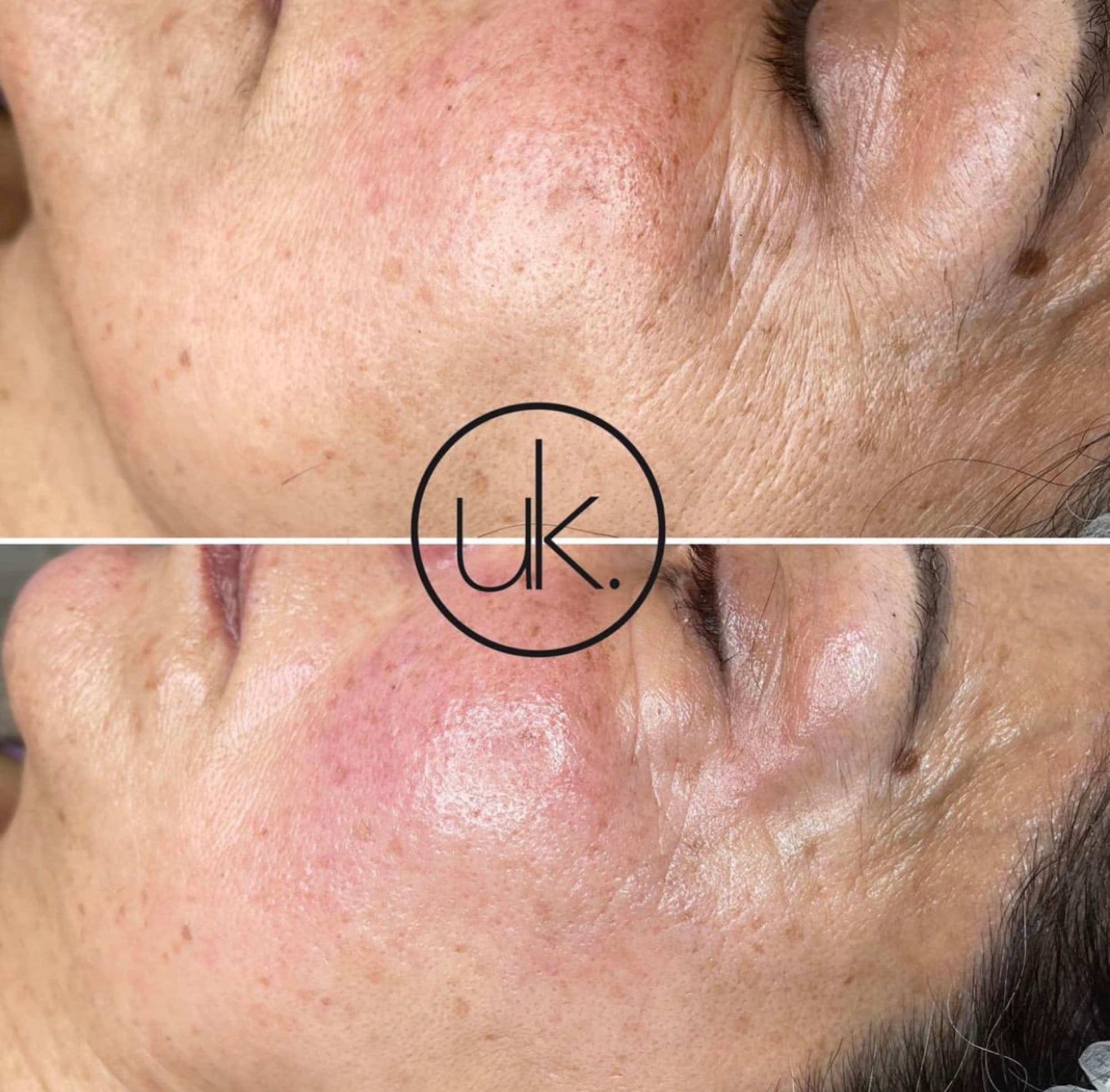 Mesotherapie in der UK Kosmetik Academy Velbert